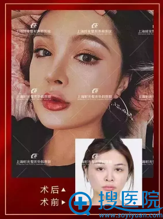 上海时光何晋龙做的颧骨和下颌角整形哪里 上海时光何晋龙做的颧骨和下颌角整形哪里