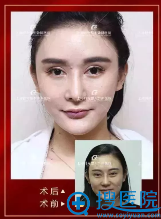 上海时光何晋龙做的颧骨下颌角和双眼皮失败修复案例 上海时光何晋龙做的颧骨下颌角和双眼皮失败修复案例