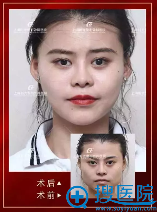 上海时光何晋龙做的颧骨整形案例 上海时光何晋龙做的颧骨整形案例