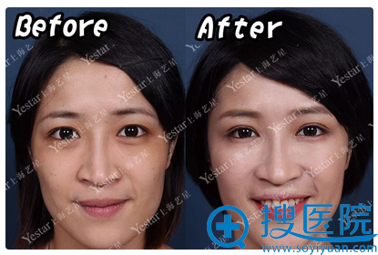 上海yestar双眼皮案例对比图 上海yestar双眼皮案例对比图