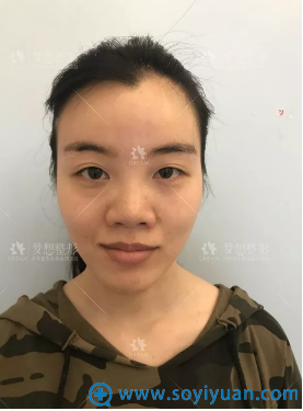 在昆明梦想找胡凯做完隆鼻后拿到一份医院双11优惠整形价格表