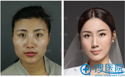 <!--<i data=20240710 data-id=12465></i>-->颧骨下颌角整形案例对比图 <!--<i data=20240710 data-id=12465></i>-->颧骨下颌角整形案例对比图