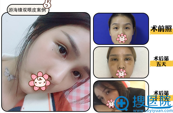 桂林华美游海锋院长双眼皮案例效果 桂林华美游海锋院长双眼皮案例效果