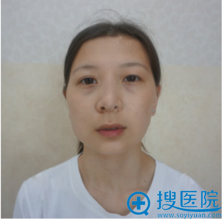 长沙星雅李雯磨骨怎么样?分享我刚做的下颌角整形案例给大家