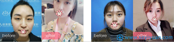 合肥恒美眼部综合整形案例 合肥恒美眼部综合整形案例