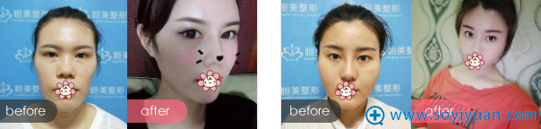 合肥恒美自体脂肪填充面部案例 合肥恒美自体脂肪填充面部案例