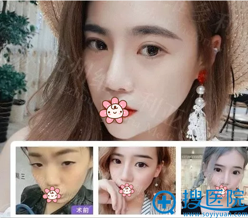 杭州维多利亚眼鼻案例招募 坐诊医生优惠价格表一览