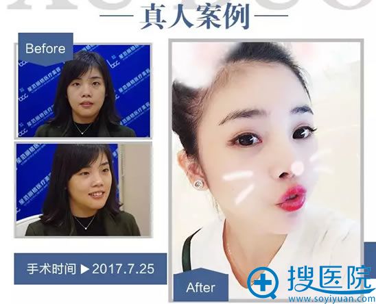 <!--<i data=20240710 data-id=11874></i>-->整形徐铎双眼皮案例 <!--<i data=20240710 data-id=11874></i>-->整形徐铎双眼皮案例