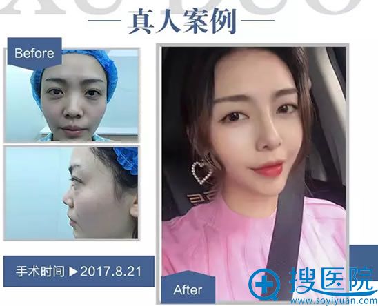 重庆徐铎做假体隆鼻真人案例 重庆徐铎做假体隆鼻真人案例