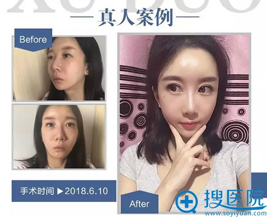 <!--<i data=20240710 data-id=11874></i>-->自体脂肪填充案例 <!--<i data=20240710 data-id=11874></i>-->自体脂肪填充案例