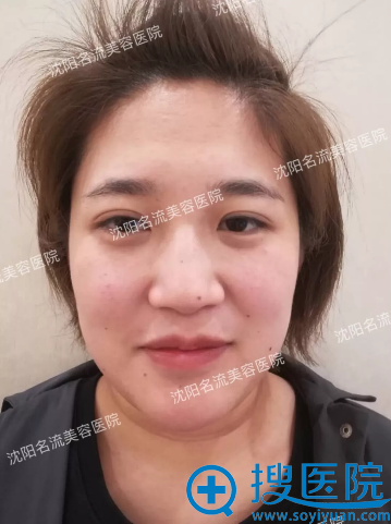 对比了沈阳百嘉丽和名流的隆鼻案例后找王松院长做了鼻综合隆鼻