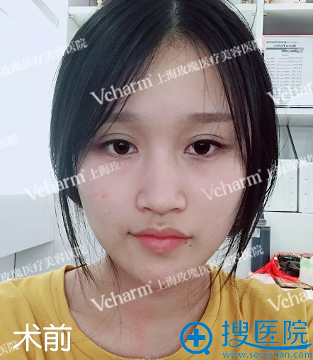 线雕隆鼻失败后我找上海玫瑰整形医院赵延峰博士做了隆鼻修复