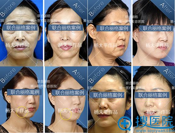 北京联合丽格杨大平抗衰老案例 北京联合丽格杨大平抗衰老案例