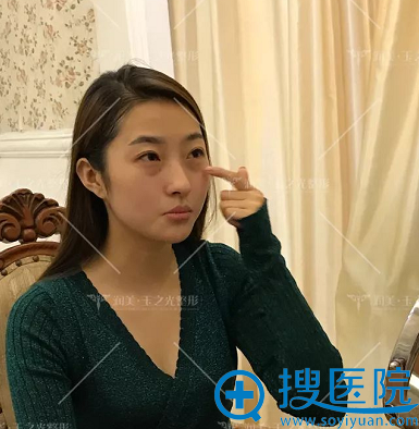 成都做脂肪填充哪家好?来看成都润美玉之光刘中国脂肪填充案例