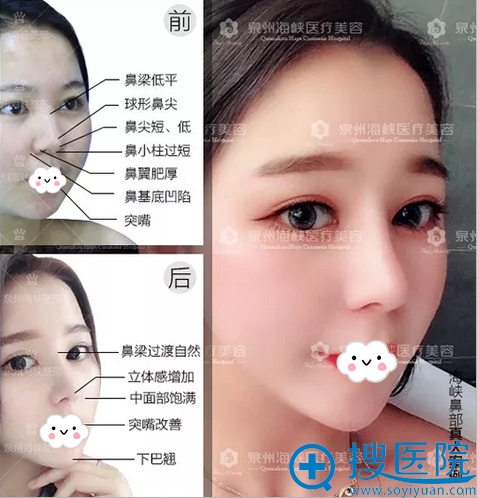 泉州海峡综合隆鼻术后效果 泉州海峡综合隆鼻术后效果