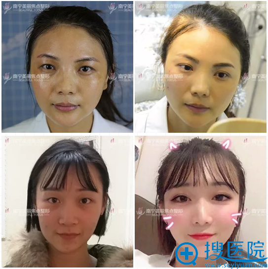南宁美丽焦点双眼皮案例 南宁美丽焦点双眼皮案例