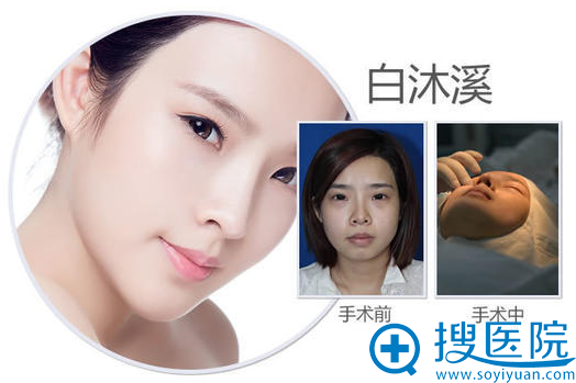 南宁美丽焦点焦俊光做的鼻综合隆鼻案例图 南宁美丽焦点焦俊光做的鼻综合隆鼻案例图