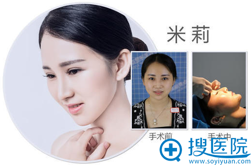 南宁美丽焦点焦俊光做的双眼皮隆鼻案例图 南宁美丽焦点焦俊光做的双眼皮隆鼻案例图