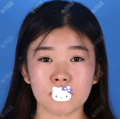 长春艾尔丽赵广文硅胶隆鼻+短鼻延长鼻头缩小综合鼻整形术后照