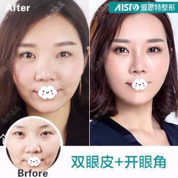 湖南割双眼皮多少钱?岳阳爱思特你美春天整形案例价格PK哪家好