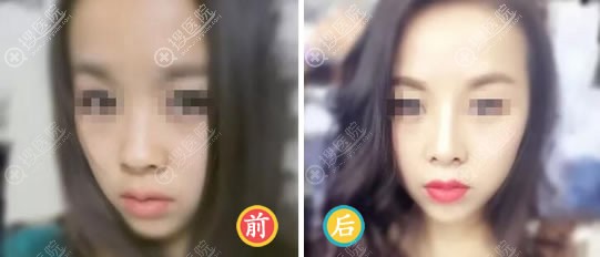 <!--<i data=20240710 data-id=12041></i>-->医美叶武锋鼻综合案例 <!--<i data=20240710 data-id=12041></i>-->医美叶武锋鼻综合案例