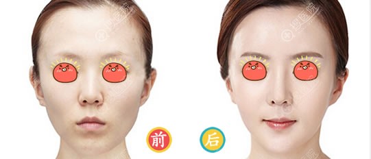 <!--<i data=20240710 data-id=12041></i>-->医美姚春莲自体脂肪填充案例 <!--<i data=20240710 data-id=12041></i>-->医美姚春莲自体脂肪填充案例
