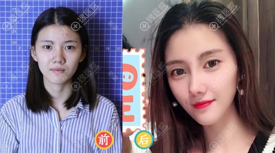 杨国梁医生肋软骨隆鼻案例 杨国梁医生肋软骨隆鼻案例