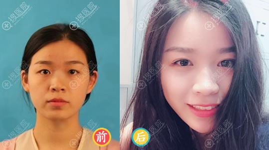 武汉艺星<!--<i data=20240710 data-id=16681></i>-->双眼皮开眼角综合手术案例 武汉艺星<!--<i data=20240710 data-id=16681></i>-->双眼皮开眼角综合手术案例
