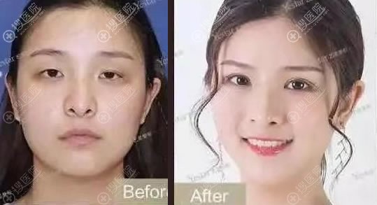朱继锋做双眼皮和开眼角综合手术案例 朱继锋做双眼皮和开眼角综合手术案例