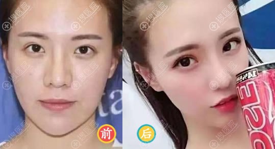 杨斐医生鼻失败修复案例效果图 杨斐医生鼻失败修复案例效果图
