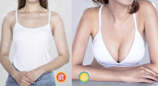 <!--<i data=20240710 data-id=16679></i>-->院长自体脂肪隆胸案例 <!--<i data=20240710 data-id=16679></i>-->院长自体脂肪隆胸案例