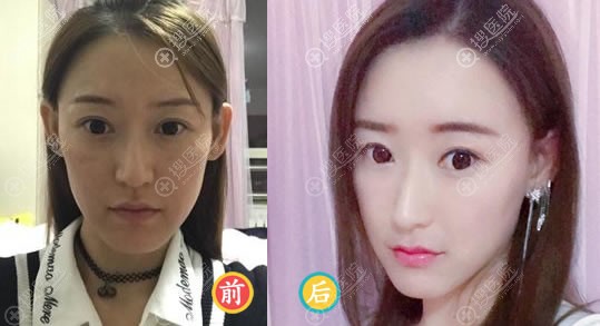 杨国梁院长自体脂肪面部填充案例 杨国梁院长自体脂肪面部填充案例
