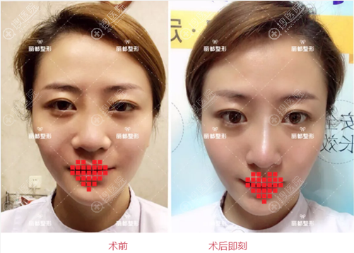 太原丽都员工整形案例 线雕隆鼻+面部线雕真实术后效果