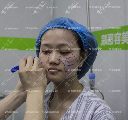 南京线雕哪家医院做的好?看南京施尔美陈锦添面部线雕真人案例