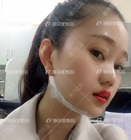 南京施尔美整形医院面部线雕术后即刻效果图 南京施尔美整形医院面部线雕术后即刻效果图