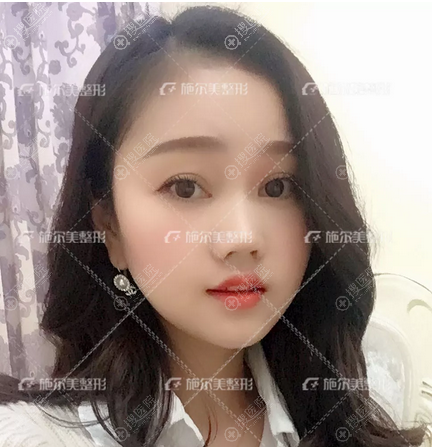 南京施尔美陈锦添做的面部线雕案例术后三天 南京施尔美陈锦添做的面部线雕案例术后三天
