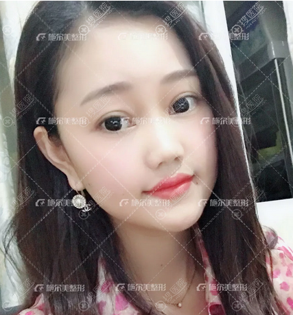南京施尔美陈锦添面部线雕真人案例 南京施尔美陈锦添面部线雕真人案例