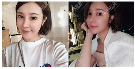 上海喜美<!--<i data=20240710 data-id=16268></i>-->做的肋软骨鼻修复案例 上海喜美<!--<i data=20240710 data-id=16268></i>-->做的肋软骨鼻修复案例