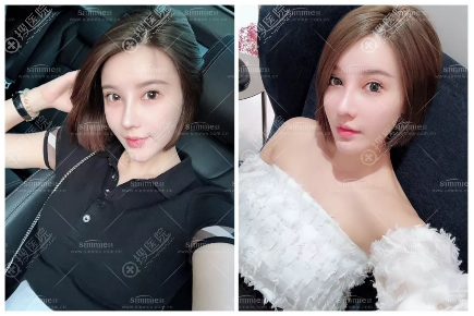 上海喜美医疗美容整形医院隆鼻失败修复案例 上海喜美医疗美容整形医院隆鼻失败修复案例