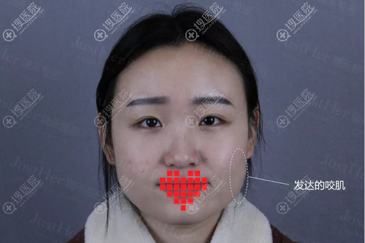 在宁波珈禾打完1个月后我又做了面部线雕 果然变成了小脸