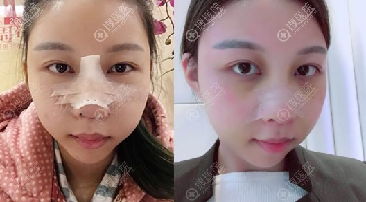 做完肋软骨隆鼻手术恢复过程图 做完肋软骨隆鼻手术恢复过程图