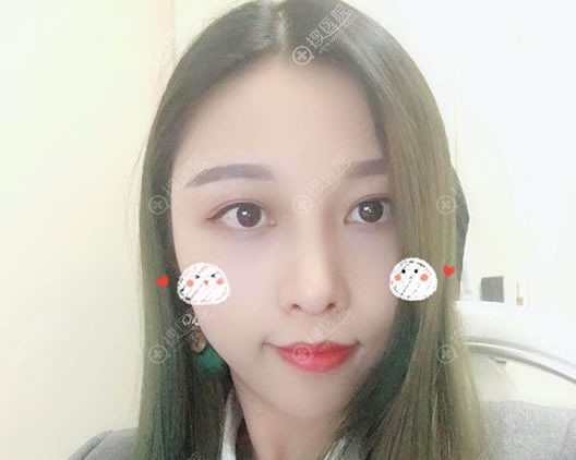 <!--<i data=20240710 data-id=10712></i>-->许小检软骨隆鼻案例10天效果 <!--<i data=20240710 data-id=10712></i>-->许小检软骨隆鼻案例10天效果