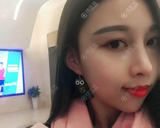 做完肋软骨隆鼻1个月恢复照 做完肋软骨隆鼻1个月恢复照