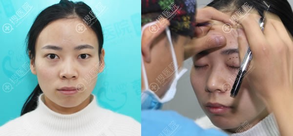 同学在宜昌蕾蒂整形做双眼皮后,我也来找李雄割双眼皮和隆下巴