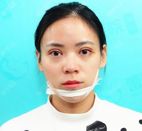 做完双眼皮手术5天恢复照 做完双眼皮手术5天恢复照