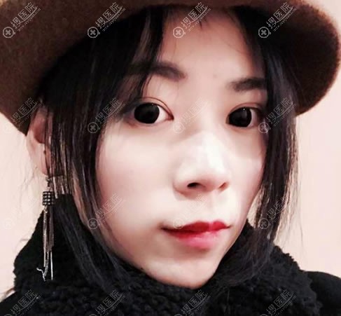 做完双眼皮15天恢复效果图 做完双眼皮15天恢复效果图