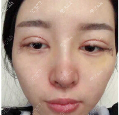 重庆华美双眼皮隆鼻案例术后5天 重庆华美双眼皮隆鼻案例术后5天