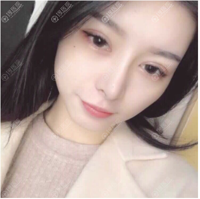 重庆华美杨丽萍做的双眼皮隆鼻真人案例 重庆华美杨丽萍做的双眼皮隆鼻真人案例