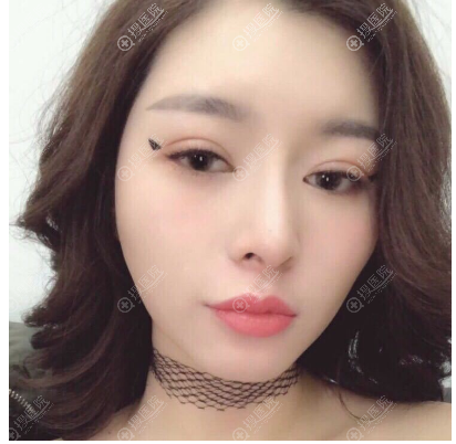 重庆华美杨丽萍做双眼皮隆鼻怎么样 重庆华美杨丽萍做双眼皮隆鼻怎么样