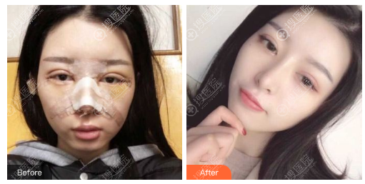 看了重庆当代和星辰的案例后找重庆华美杨丽萍做的双眼皮隆鼻